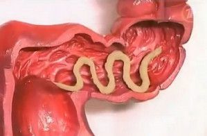 treatment worms