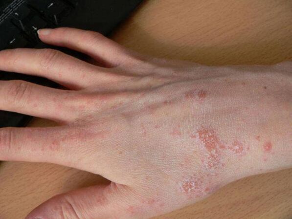 scabies on the hands with subcutaneous lice
